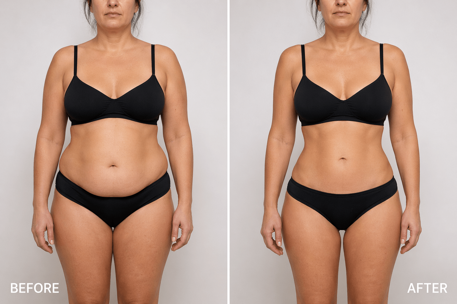 lipo 360 without tummy tuck surgery